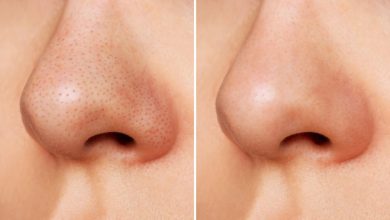 Skin Care Tips: ब्लैकहेड्स से हैं परेशान? जानिए चेहरे से लेकर पीठ तक हटाने के असरदार घरेलू नुस्खे