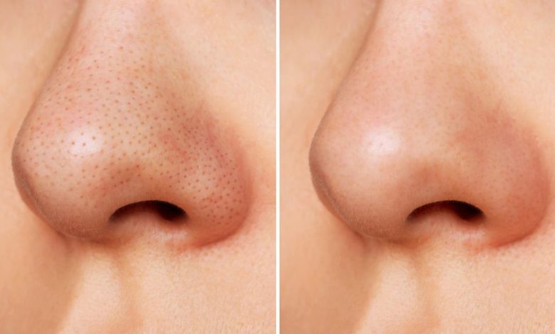 Skin Care Tips: ब्लैकहेड्स से हैं परेशान? जानिए चेहरे से लेकर पीठ तक हटाने के असरदार घरेलू नुस्खे
